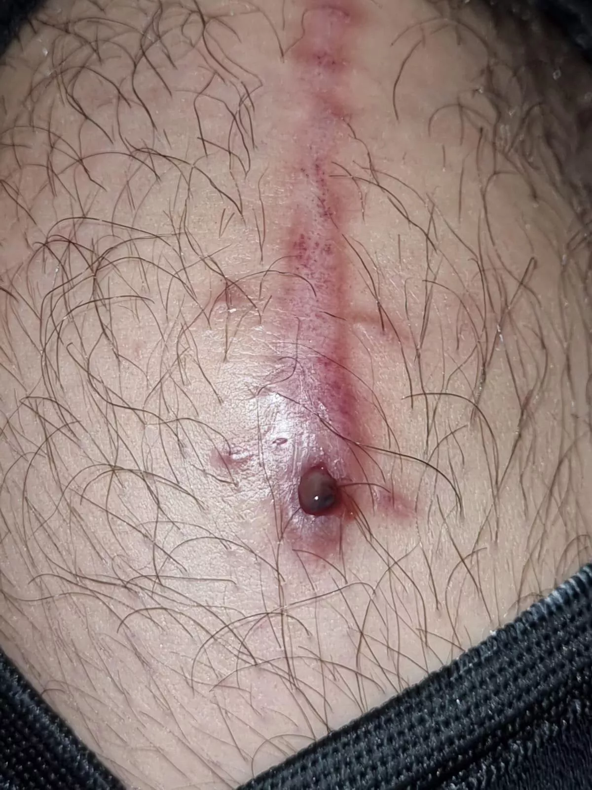 This popped out of my knee scar, a month after surgery