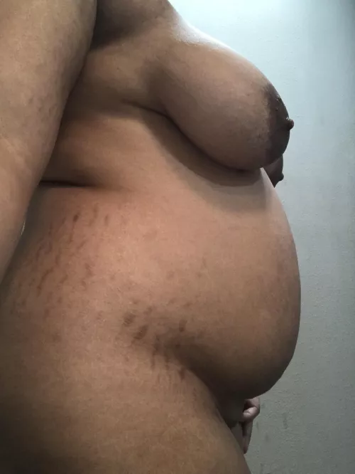 Stretch marks from growing too fast 😅