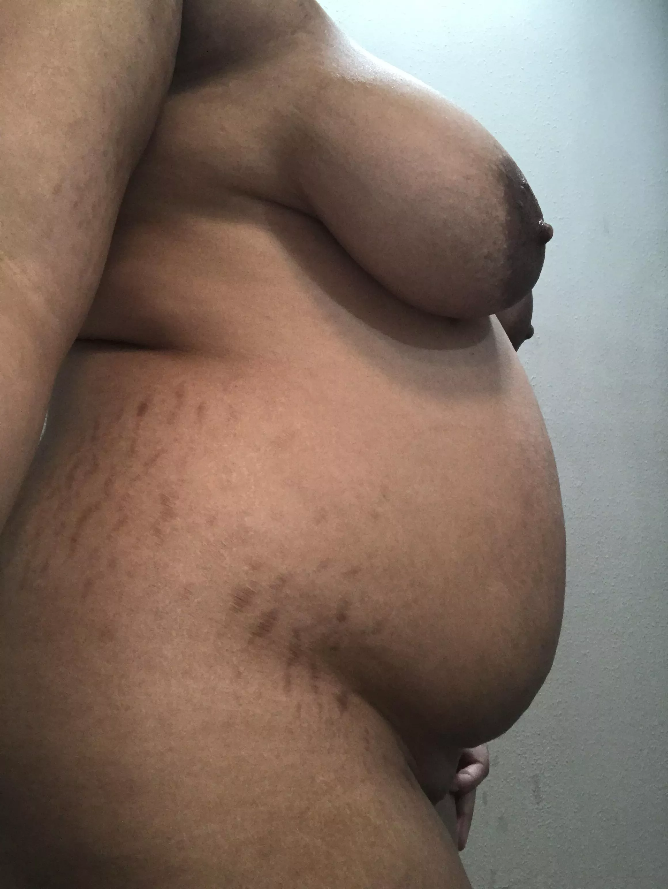 Stretch marks from growing too fast 😅