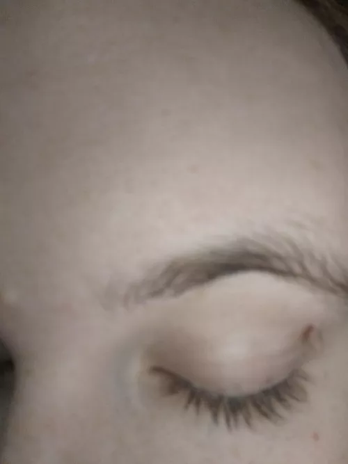 How to remove this skin tag?