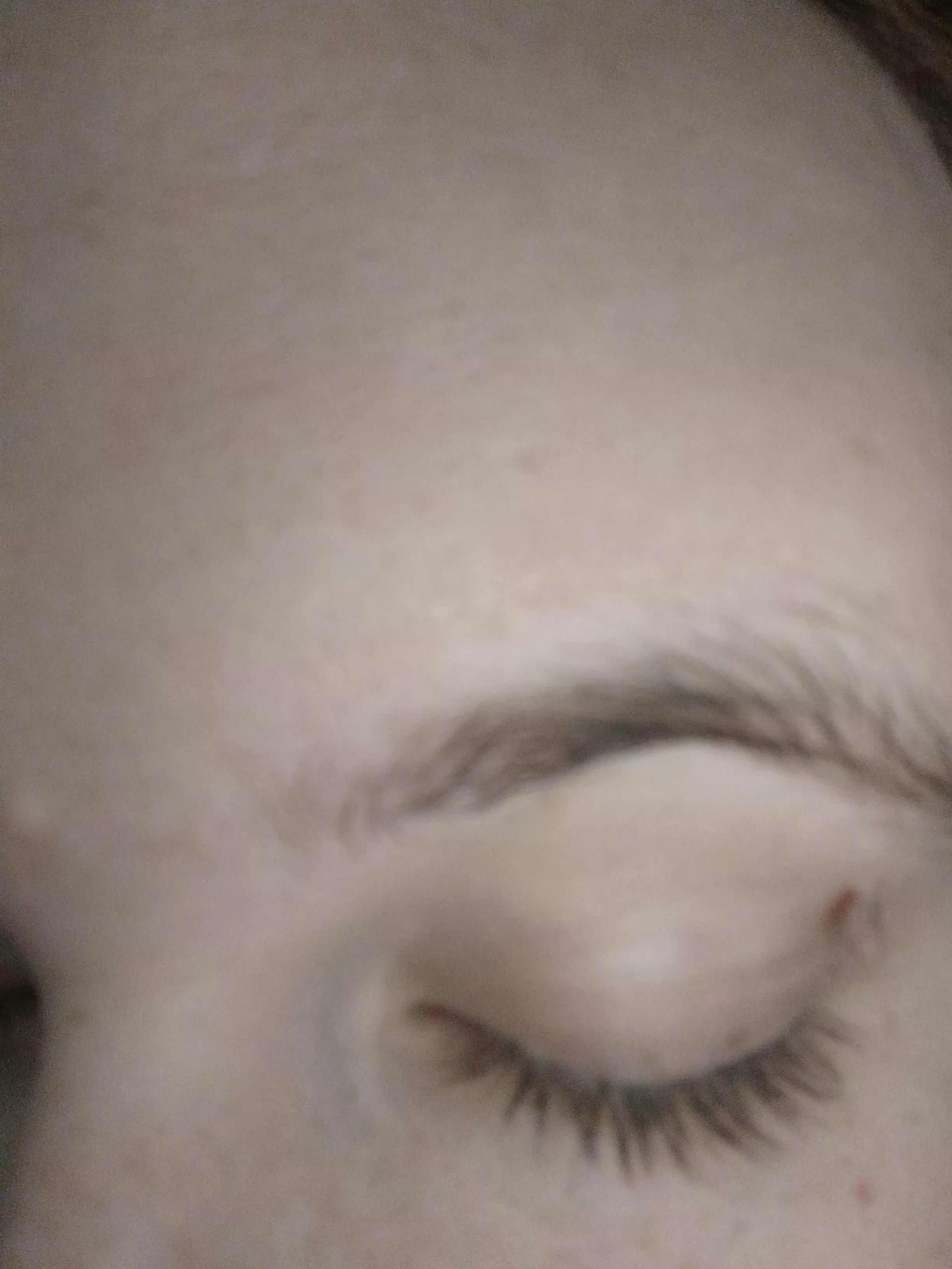 How to remove this skin tag?