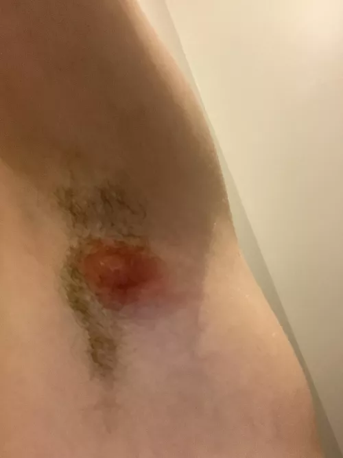 Massive abscess on armpit,stay tuned for possible lancing video tomorrow?
