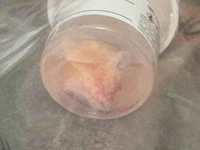 Cystectomy earlier this week