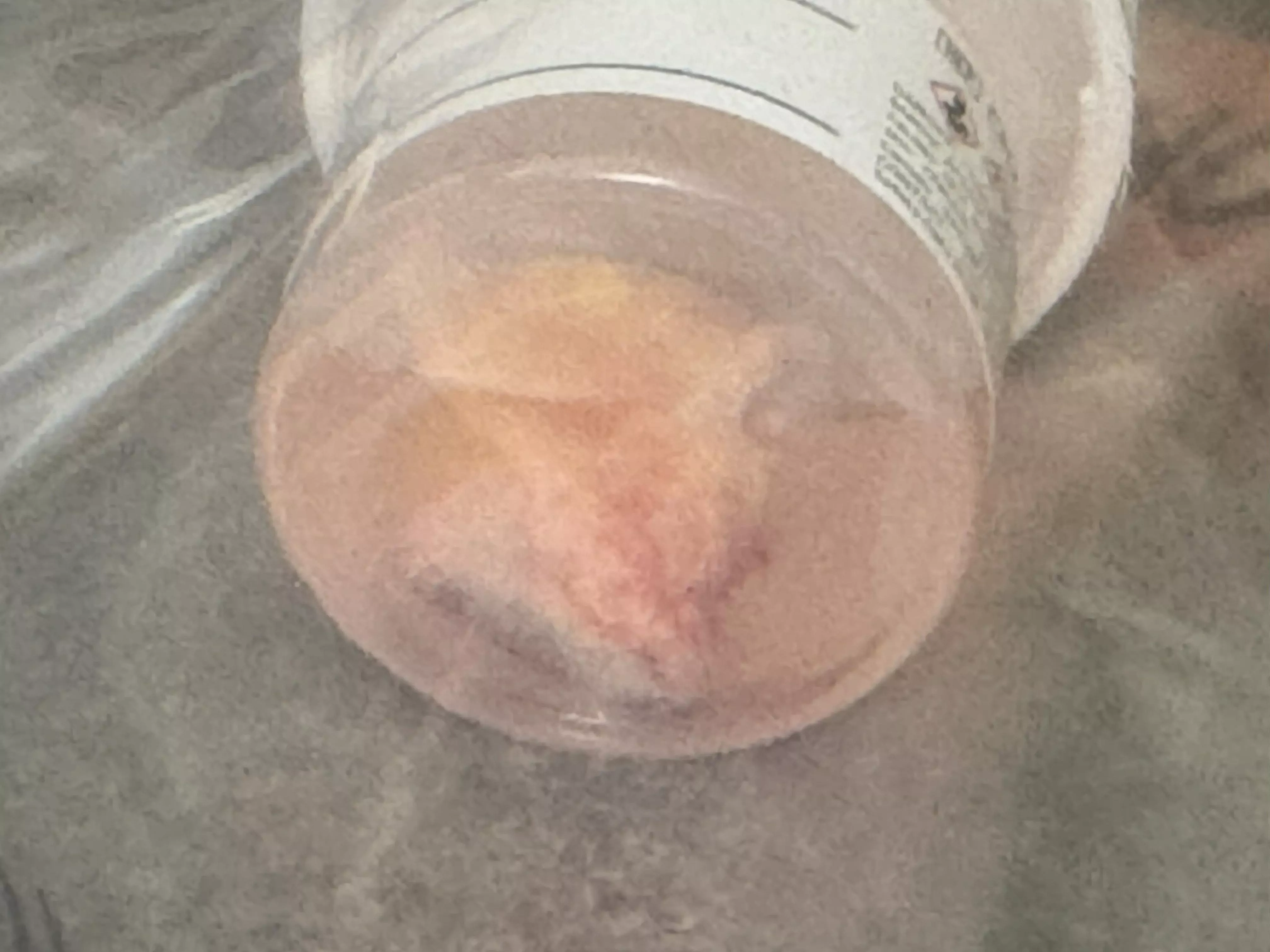 Cystectomy earlier this week