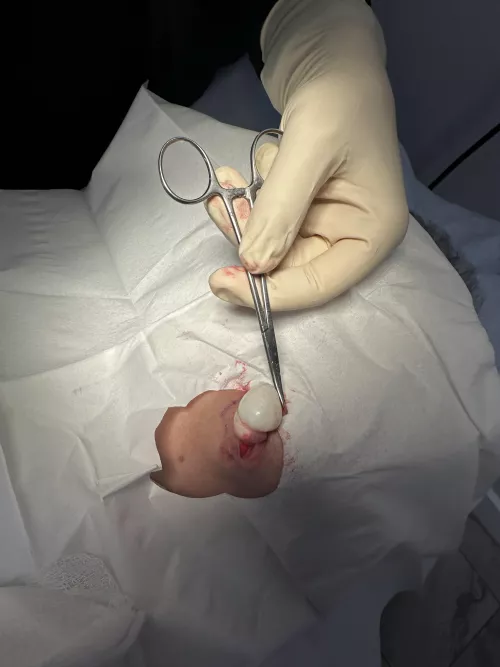 Surgical removal of Cyst