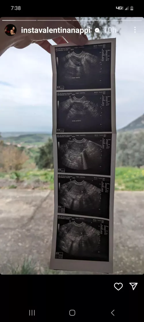 Valentina pregnant?