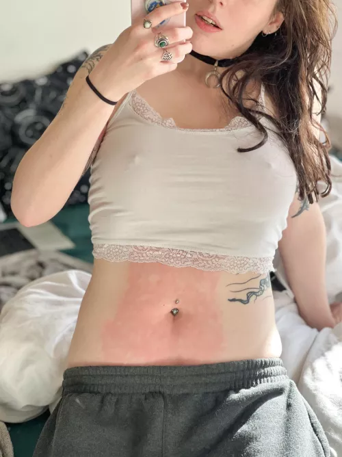 Lazy Sunday featuring hot water bottle burn marks
