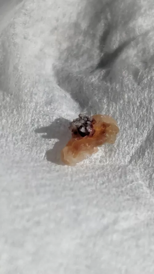 This wart that fell off my face after being frozen looks like a Nudibranch