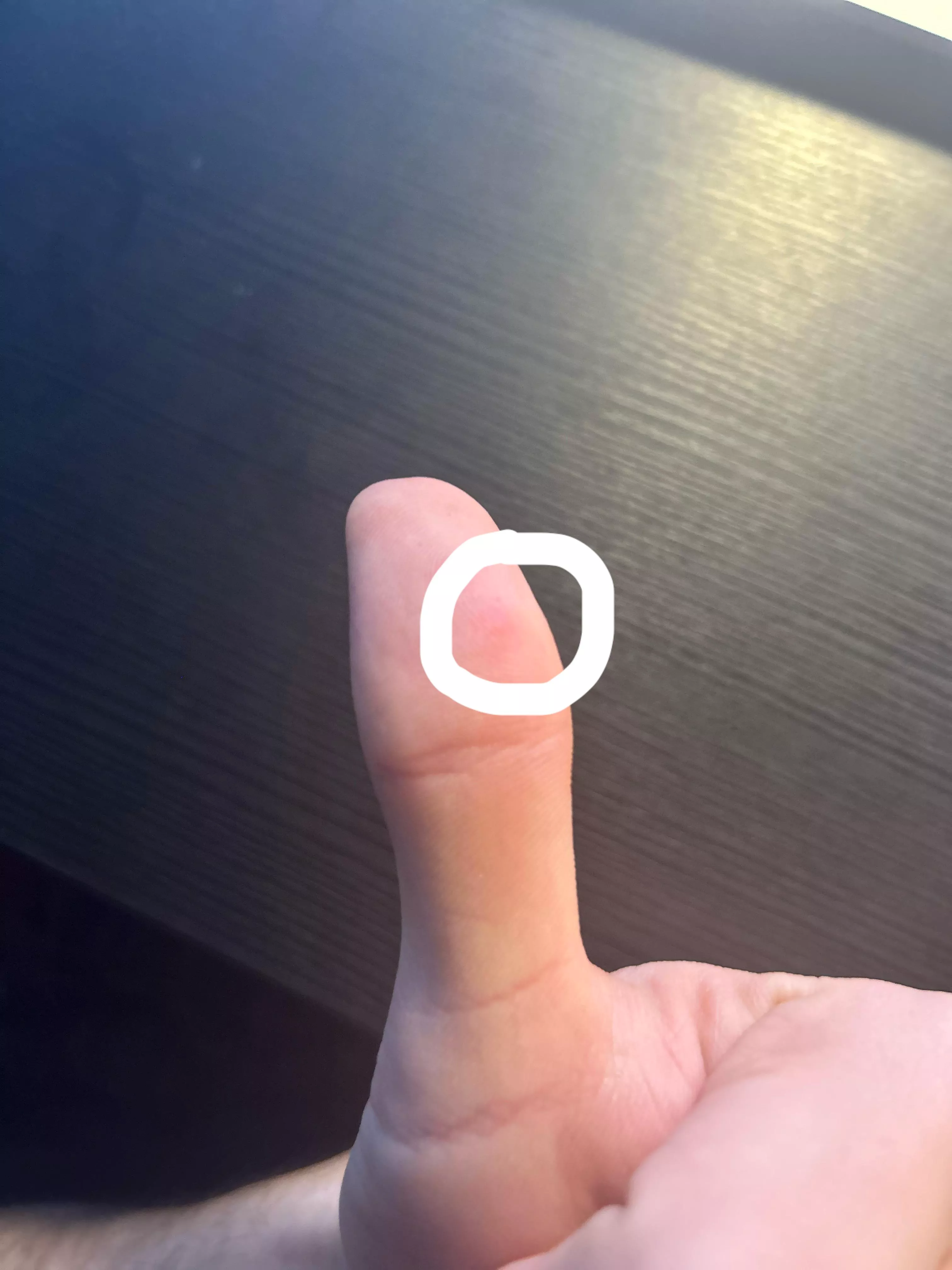 This weird white dot on my thumb hurts when it’s squeezed or pressed hard. What is it?