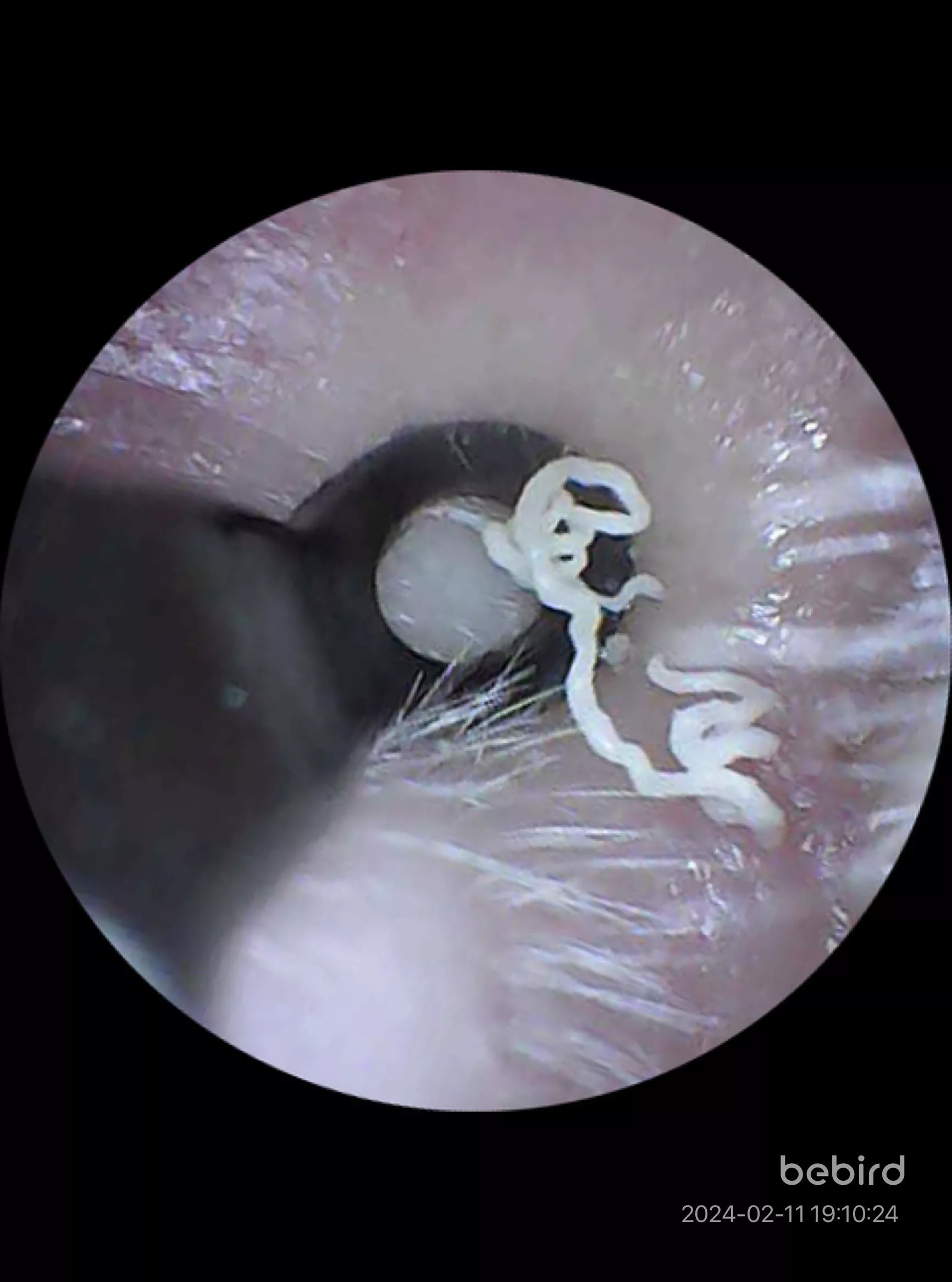 Ear blackhead that pops every so often