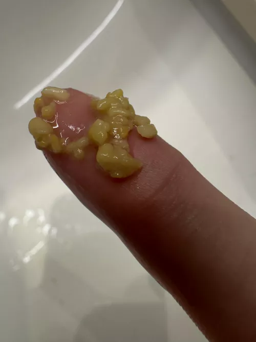 I woke up and could feel these tonsil stone in my mouth