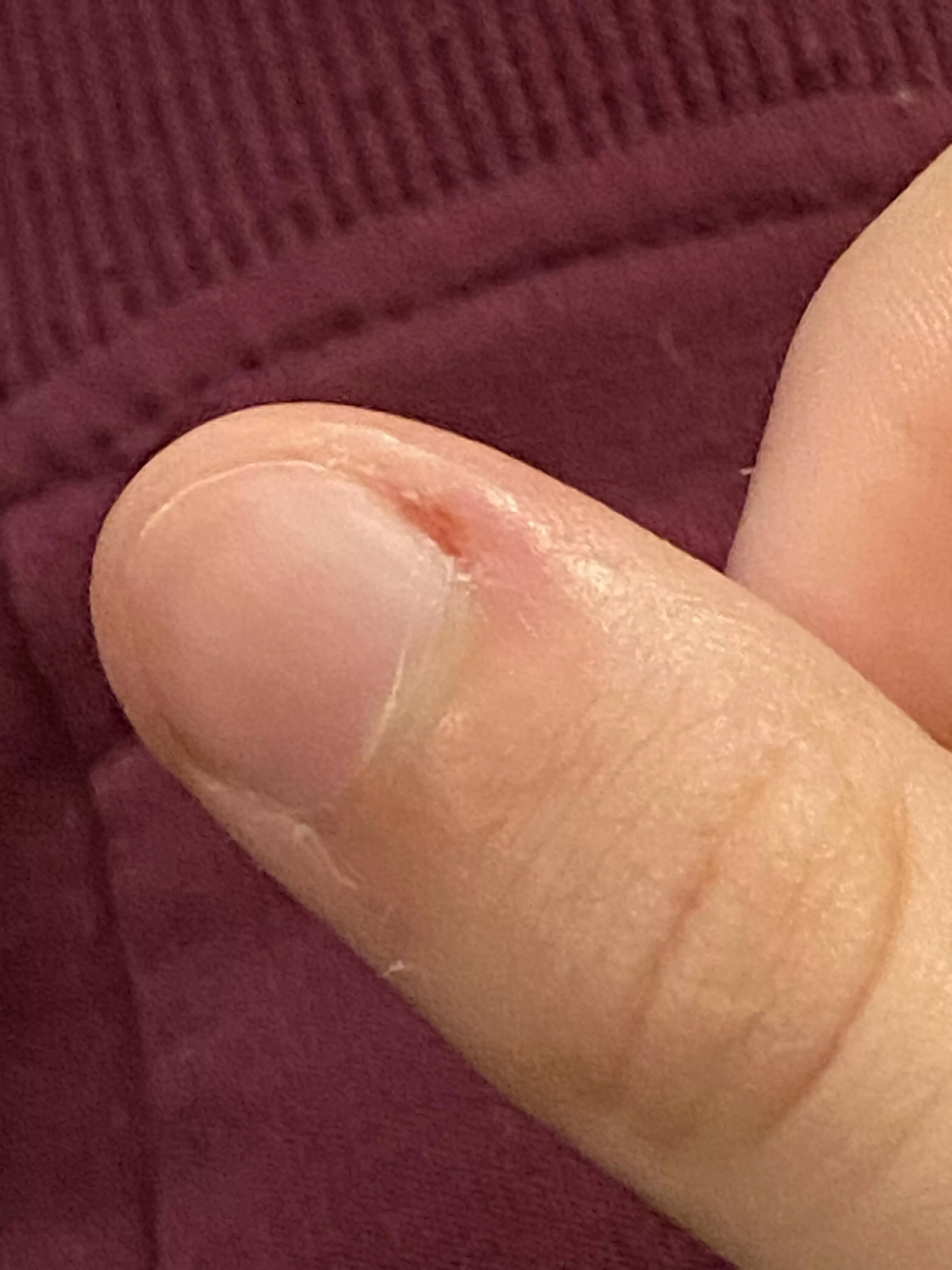 Potential paronychia