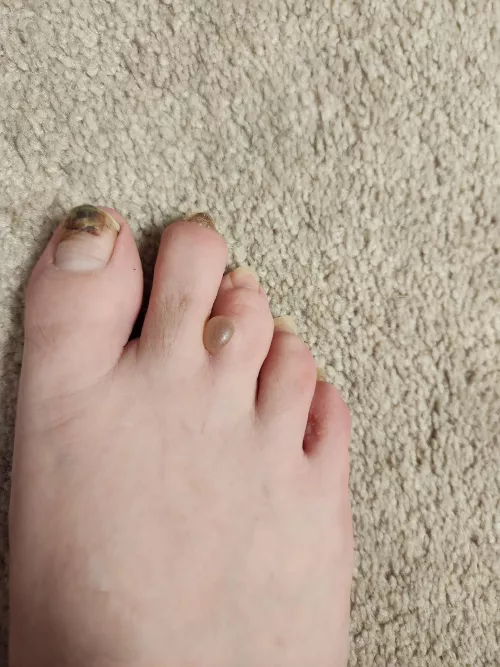 Athletes foot blister.