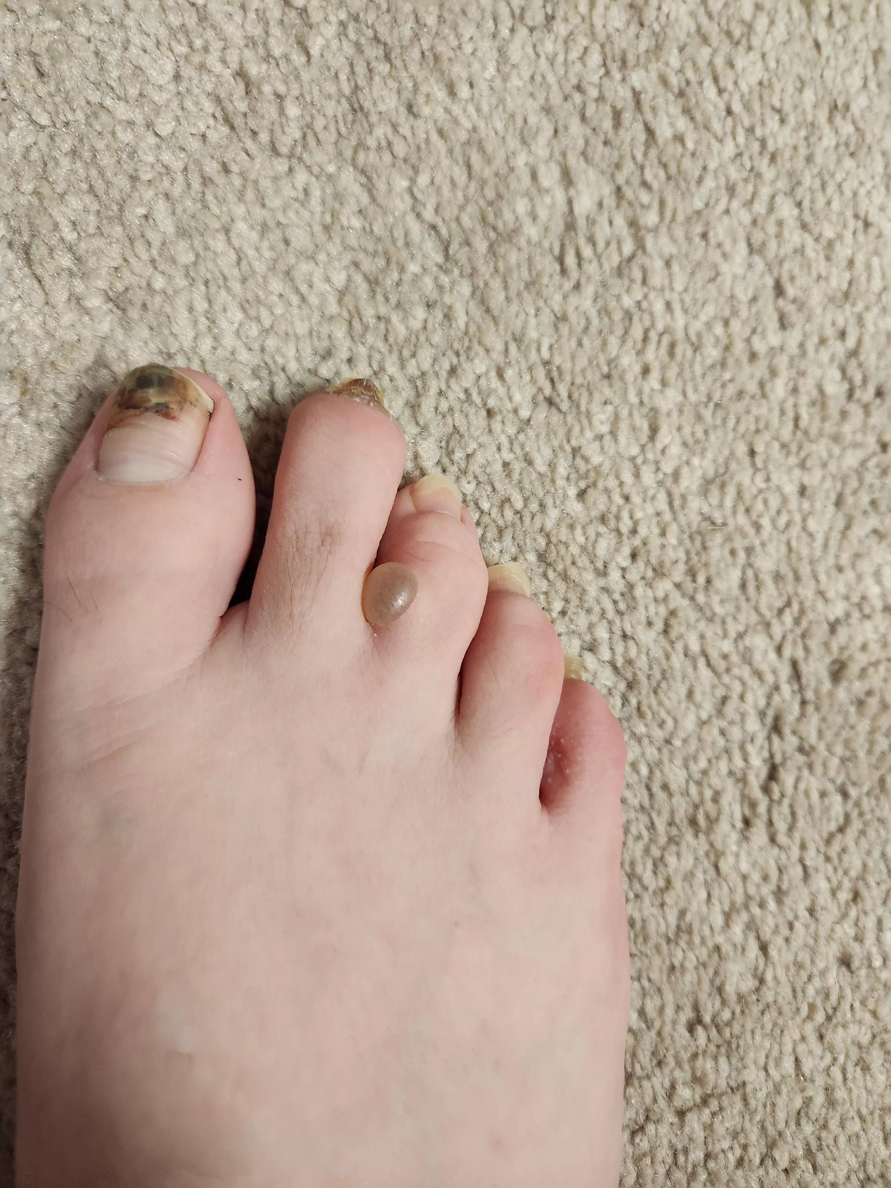 Athletes foot blister.