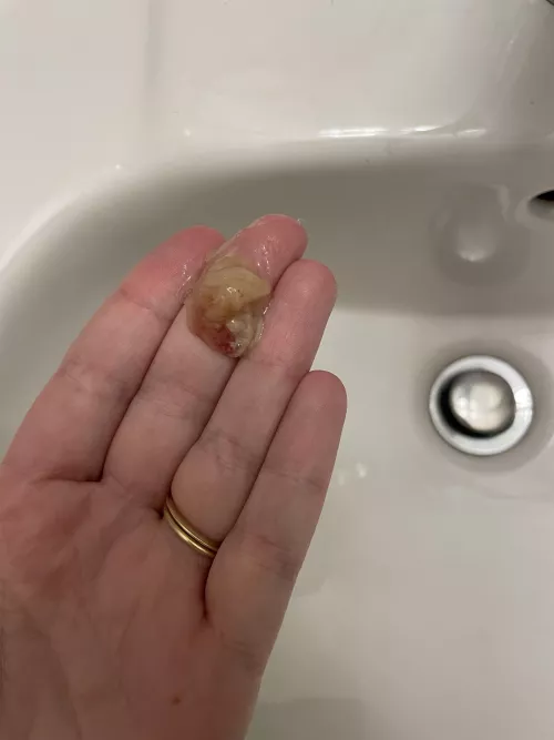 Felt this come out - dealing with strep throat