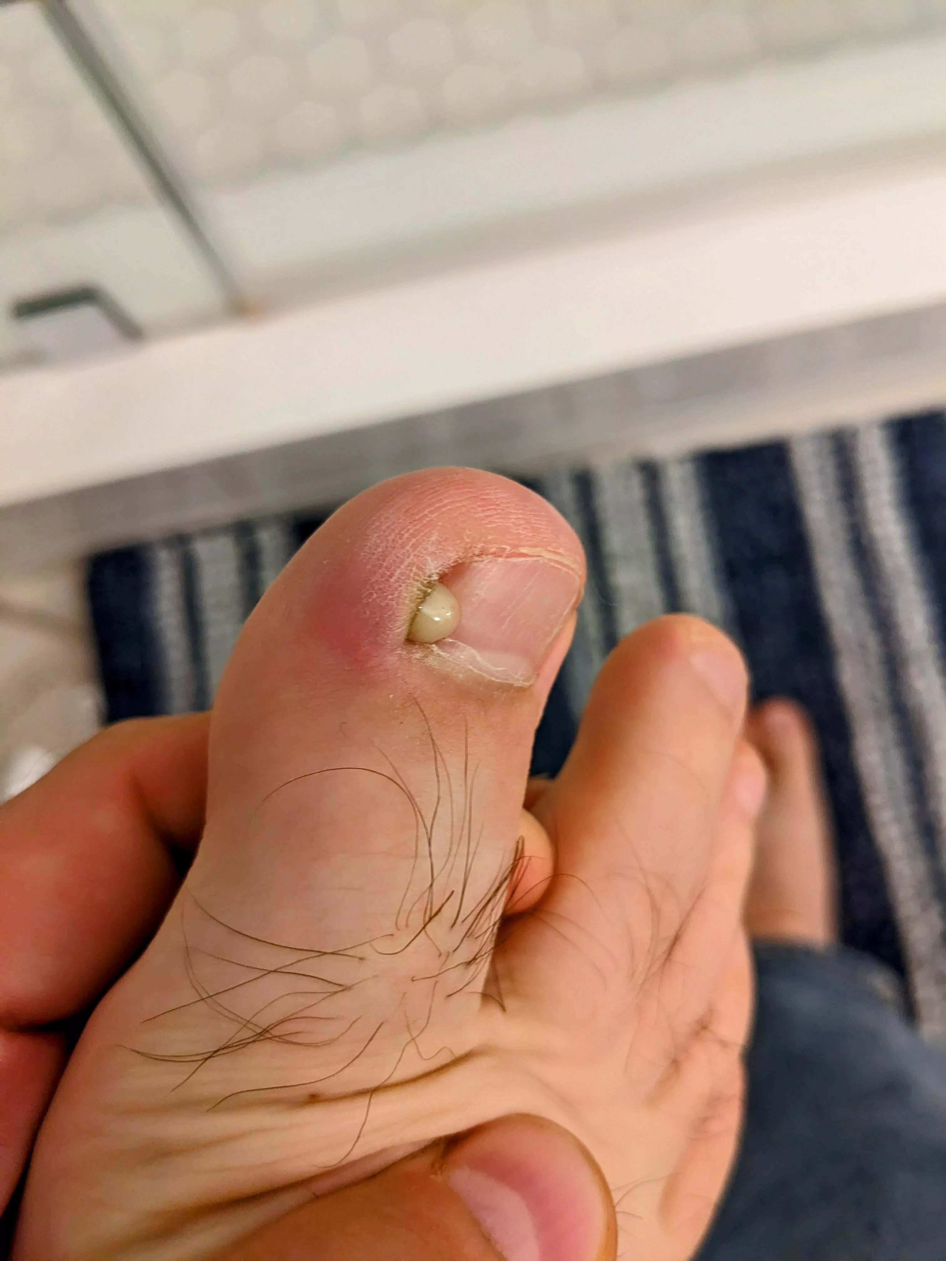 Ingrown toenail pop!