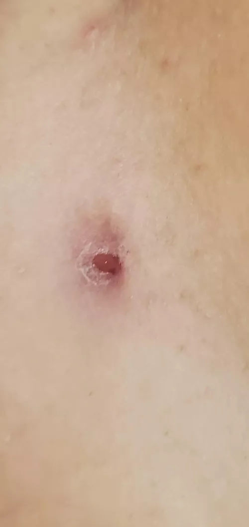 Bikini line cyst/abscess help :(