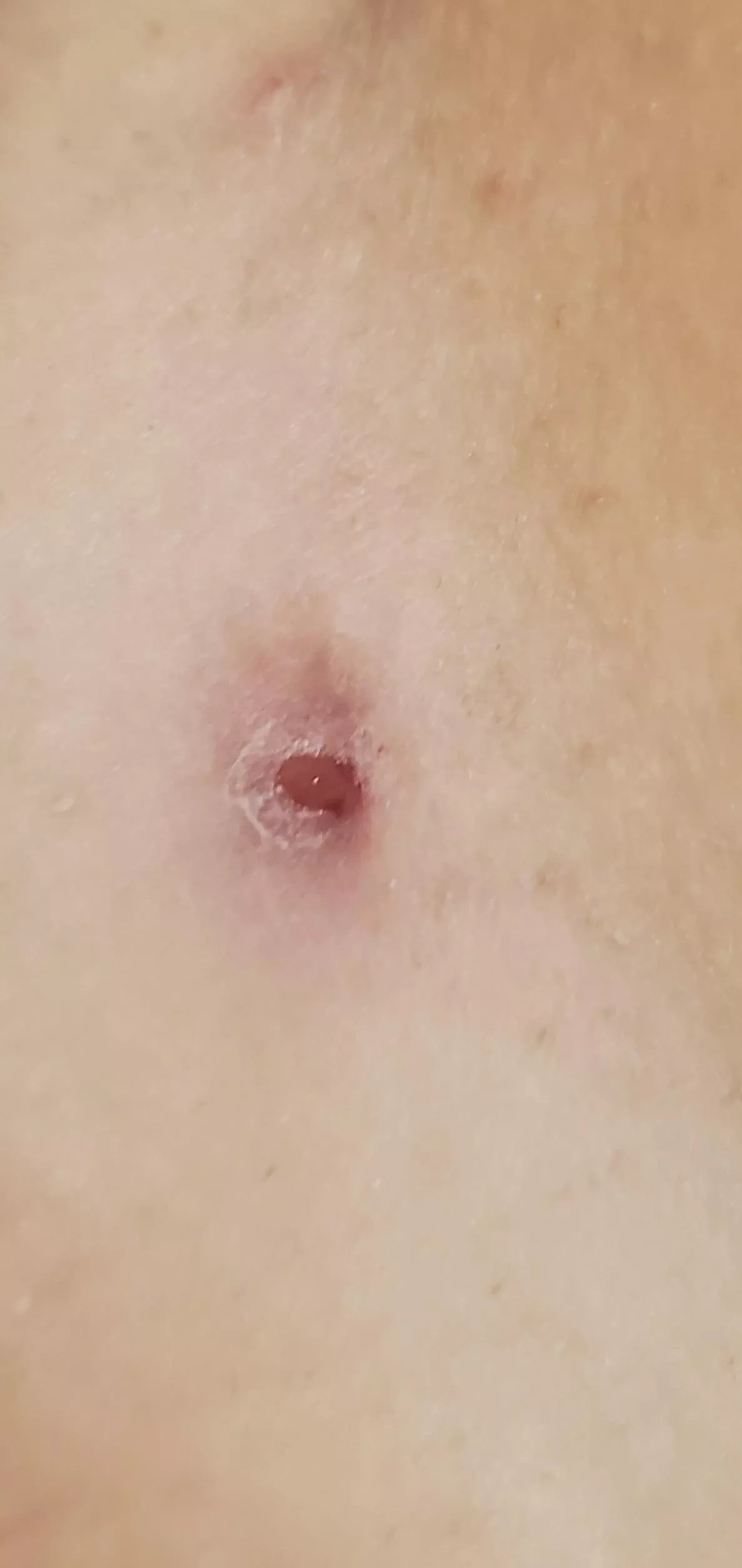 Bikini line cyst/abscess help :(