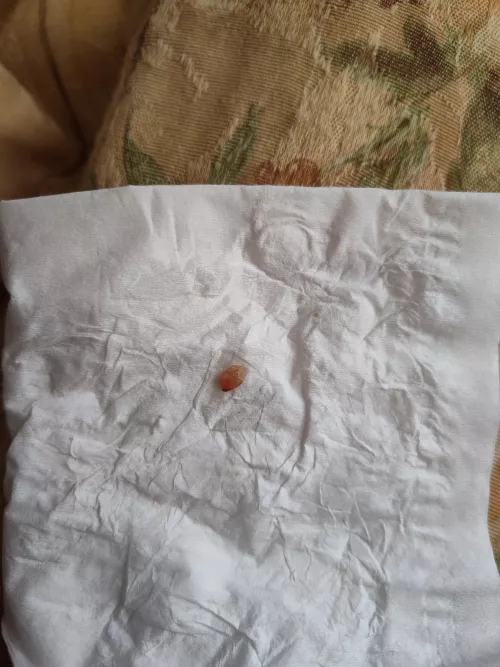 A rather odd cyst core.