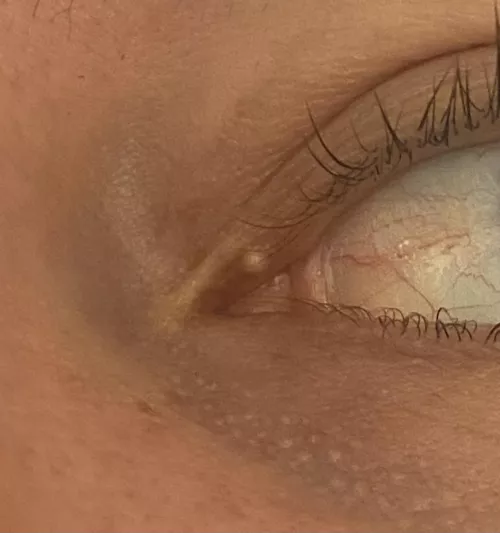 Where do I go to get this taken care of? Milia?