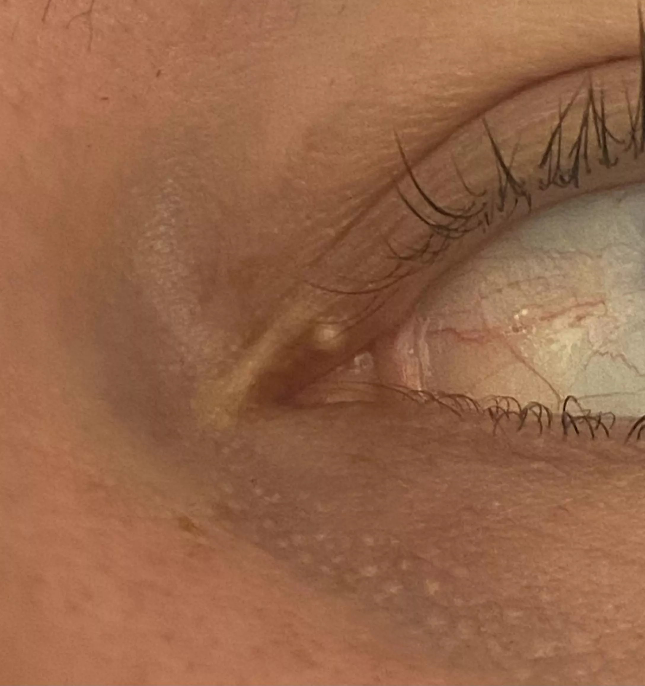 Where do I go to get this taken care of? Milia?