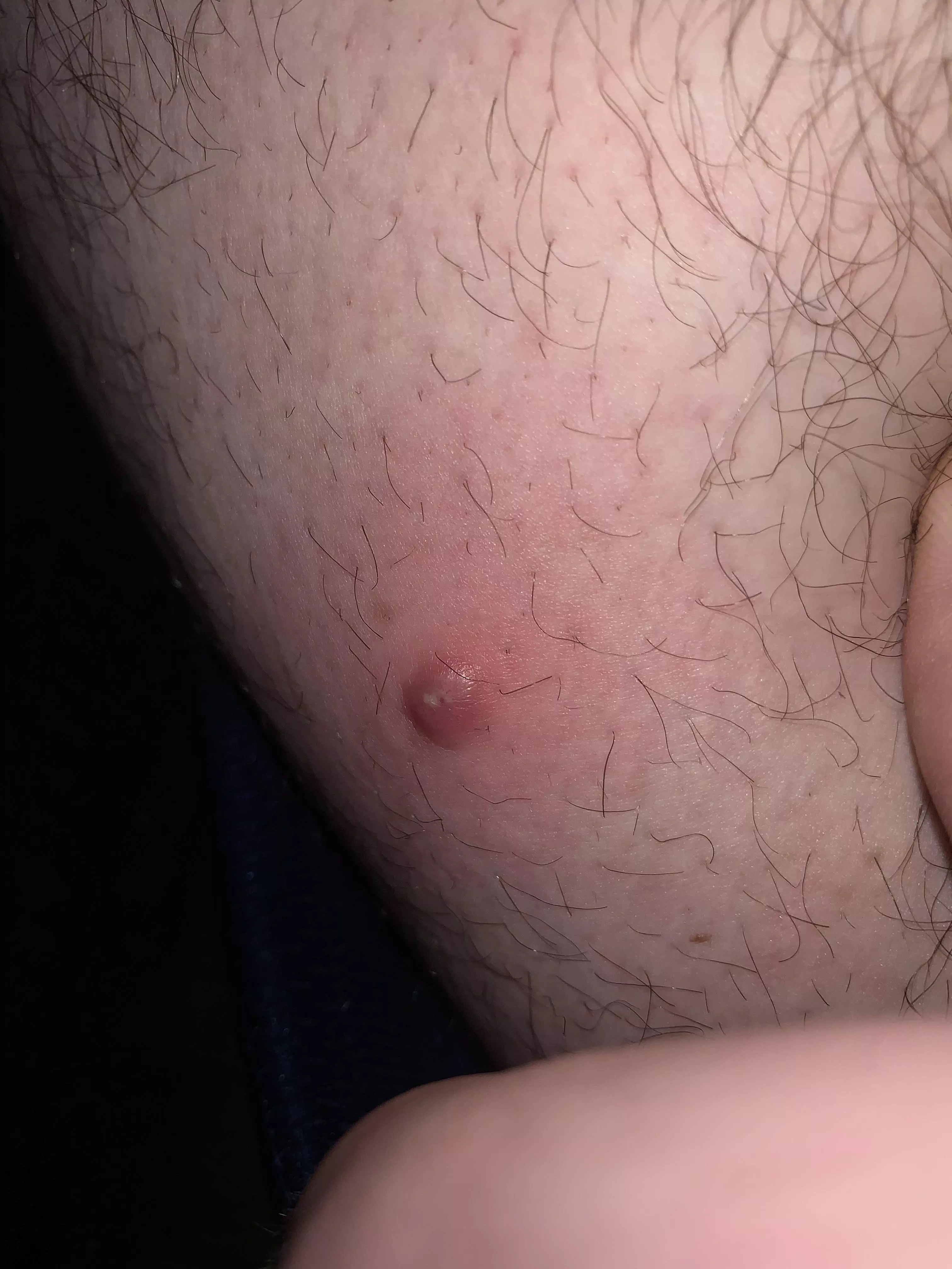 Angry red bumps on thigh