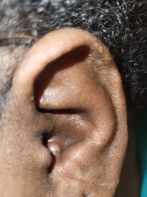 Pimple in ear that won't go away