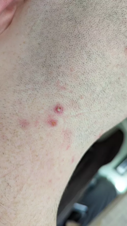 Pimple on the back of my head. 