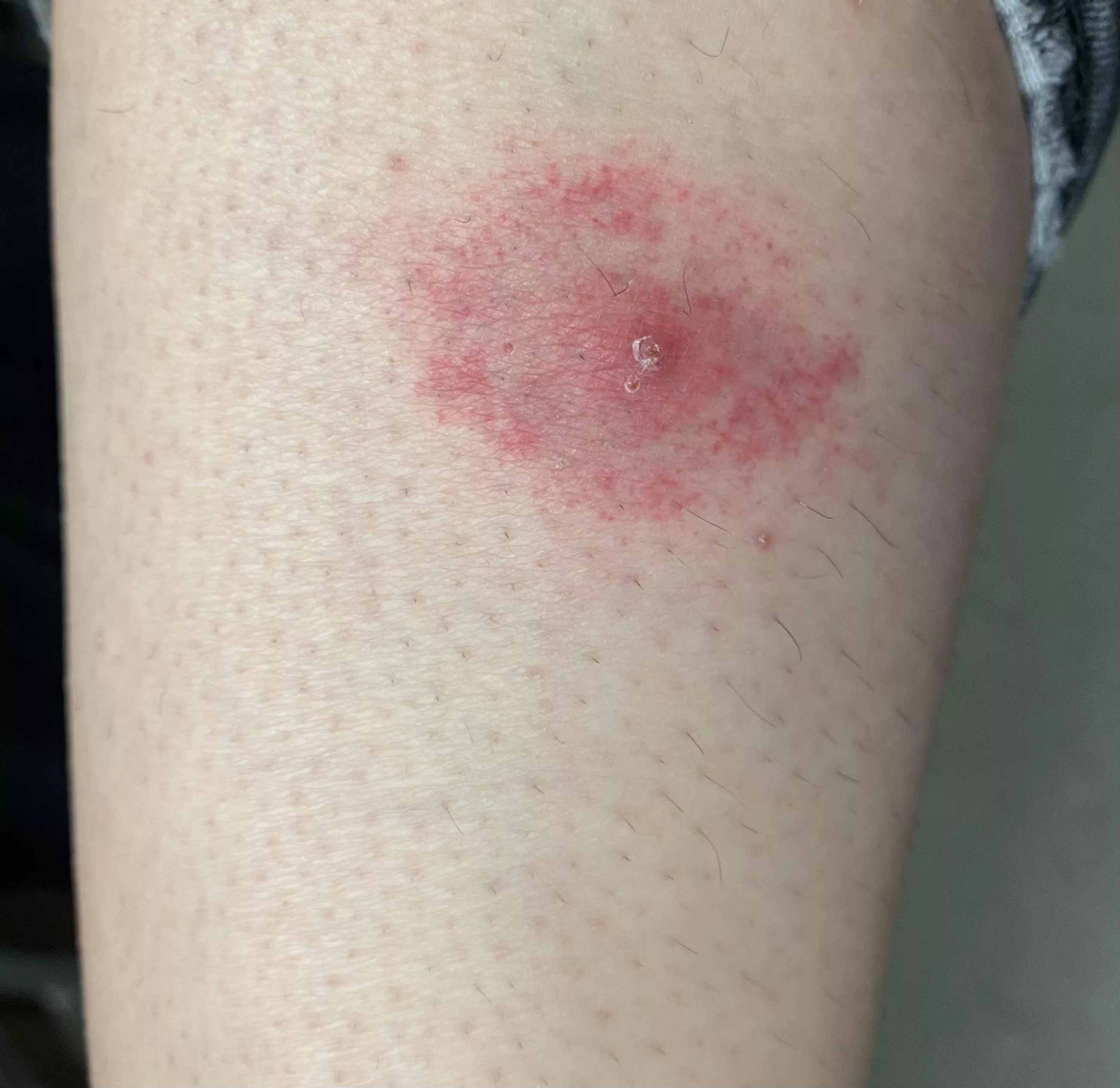 Is this a spider bite or something? I’m from Australia. It started out as just a pimple and now looks like this and i accidentally shaved over it and some puss came out. Otherwise I’ll go to a doctor if need be