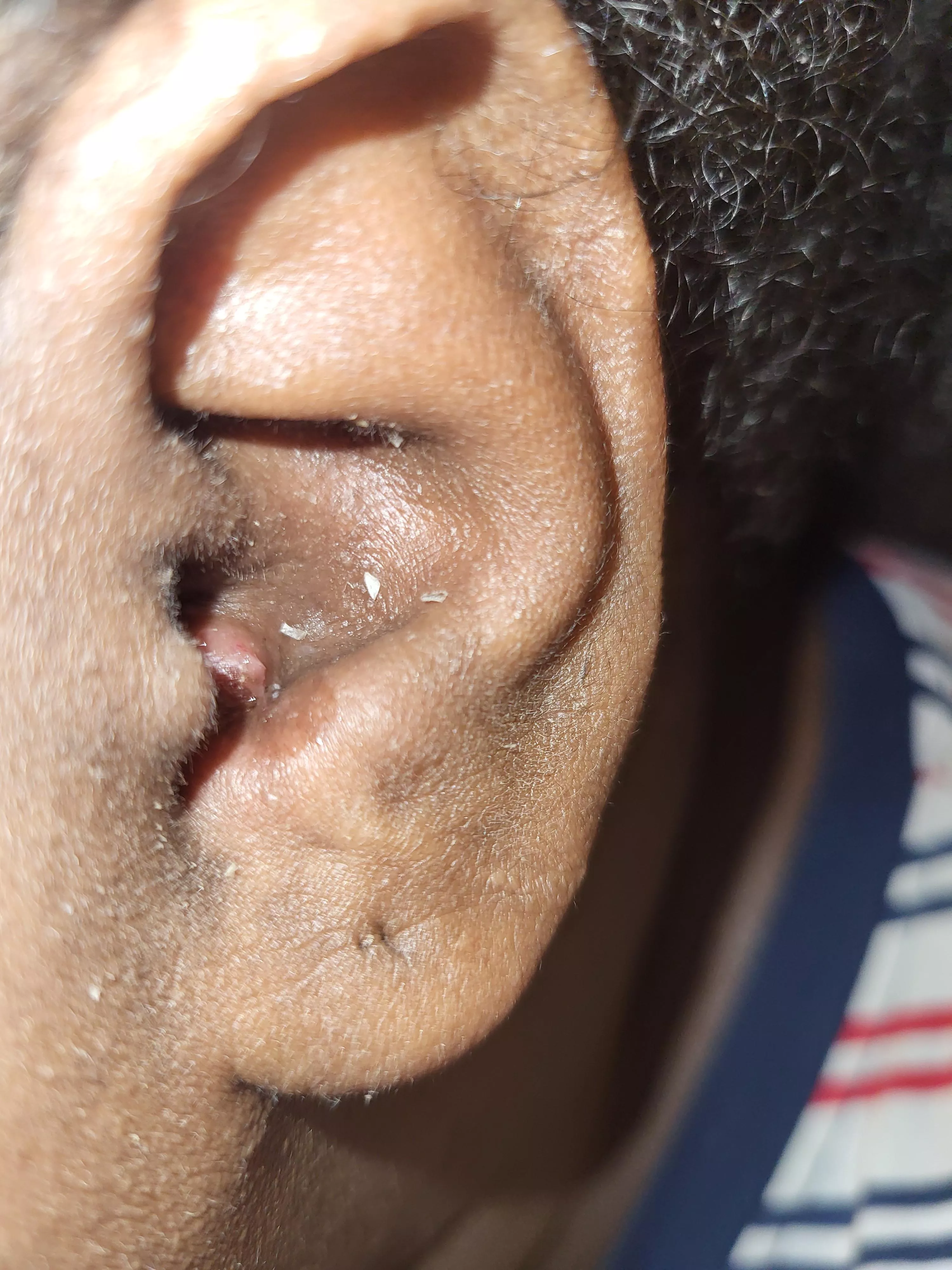 Painful Pimple in ear that won't leave part 2