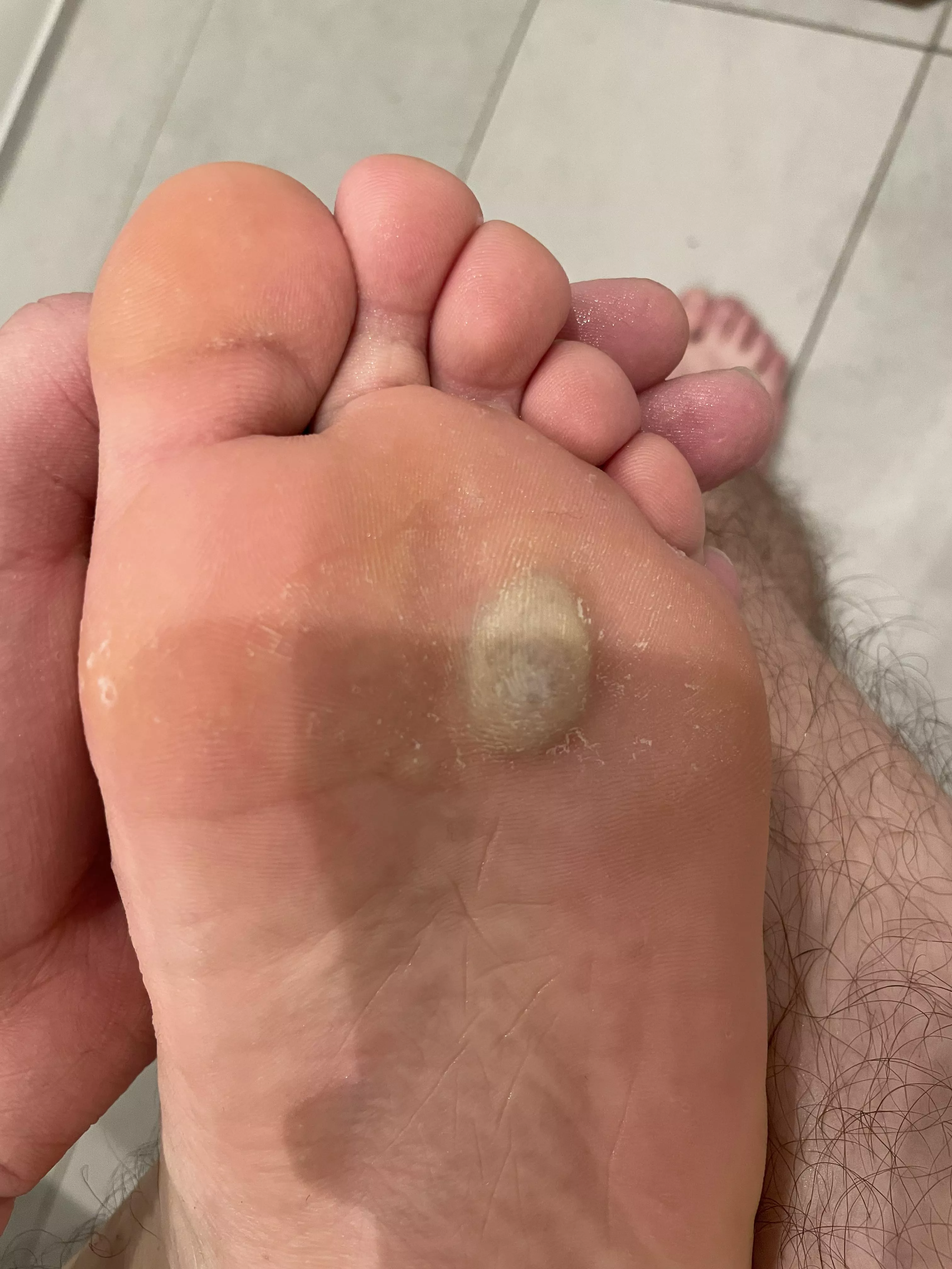 blister on the bottom of foot