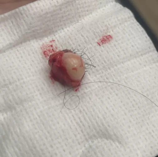 Got this sebaceous cyst removed from my scalp today. Measured about an inch across.