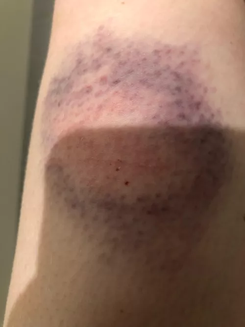 A fly wacker on my leg