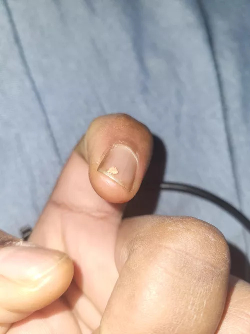 Ear pimple that won't leave part 3 (the end)