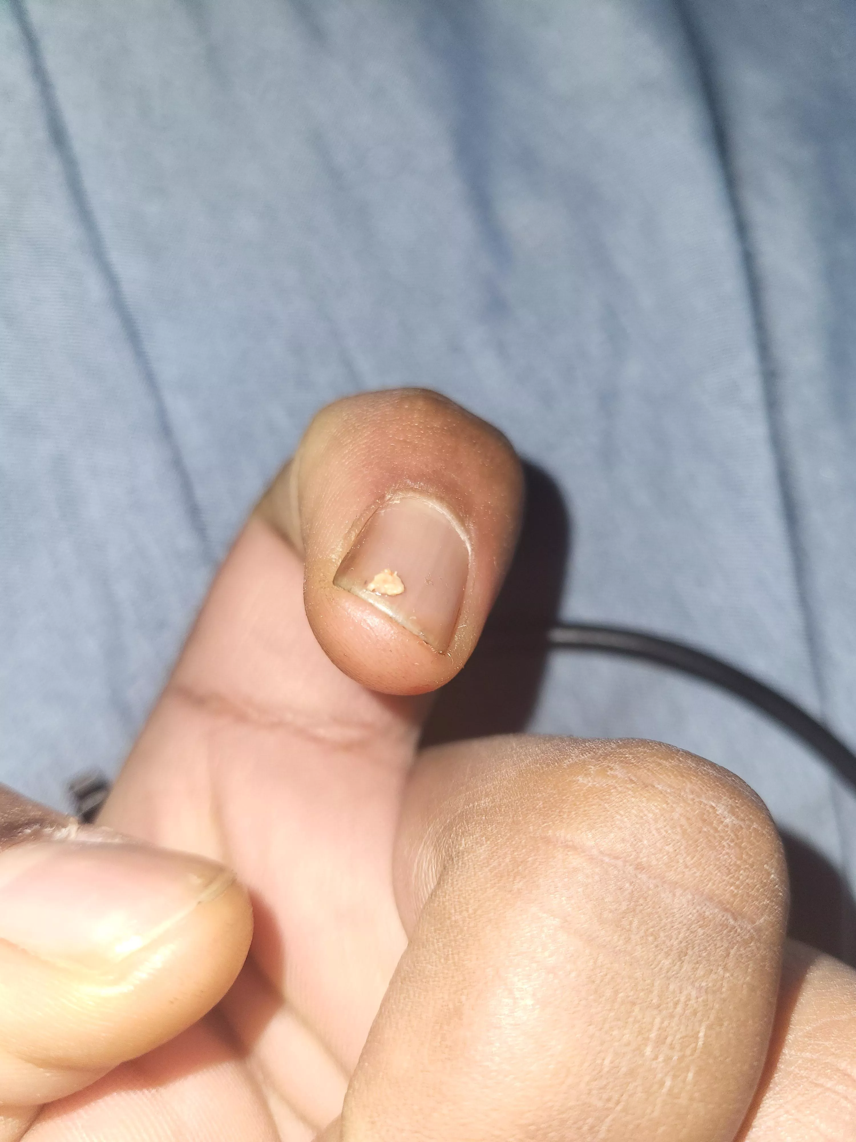 Ear pimple that won't leave part 3 (the end)