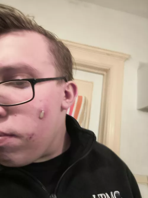 Face stuff. Been using cervae, doxycycline and face wash twice a day. 