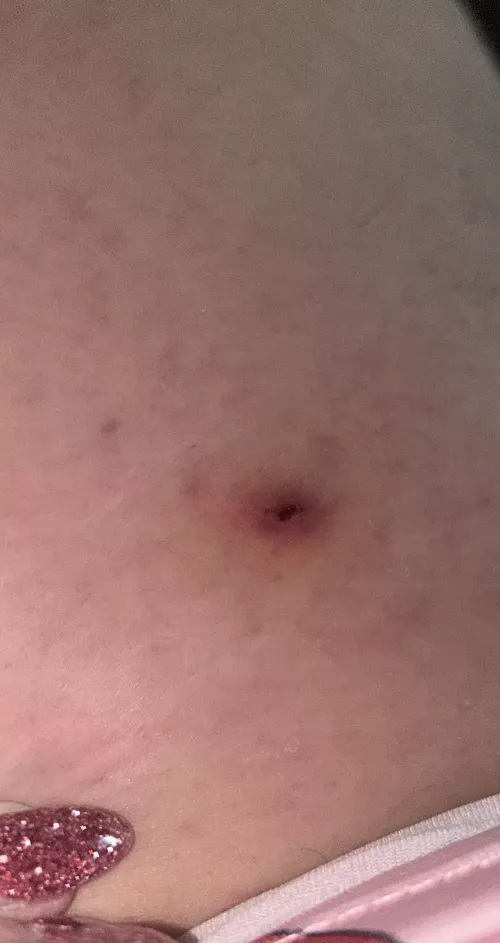 Help??? Does this look like an ingrown hair?? On upper thigh 
