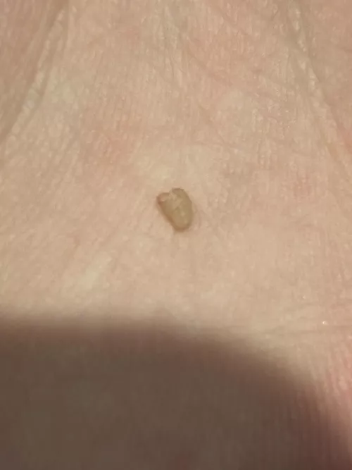 I popped and pulled this out of what started as an ingrown hair on my private part… any idea what it is? A cyst? 