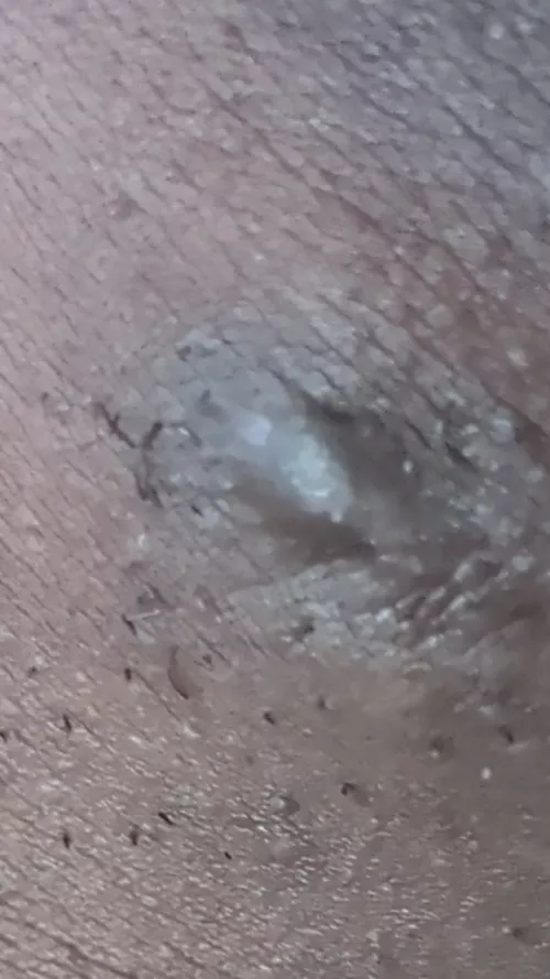 Face cyst flattening technique