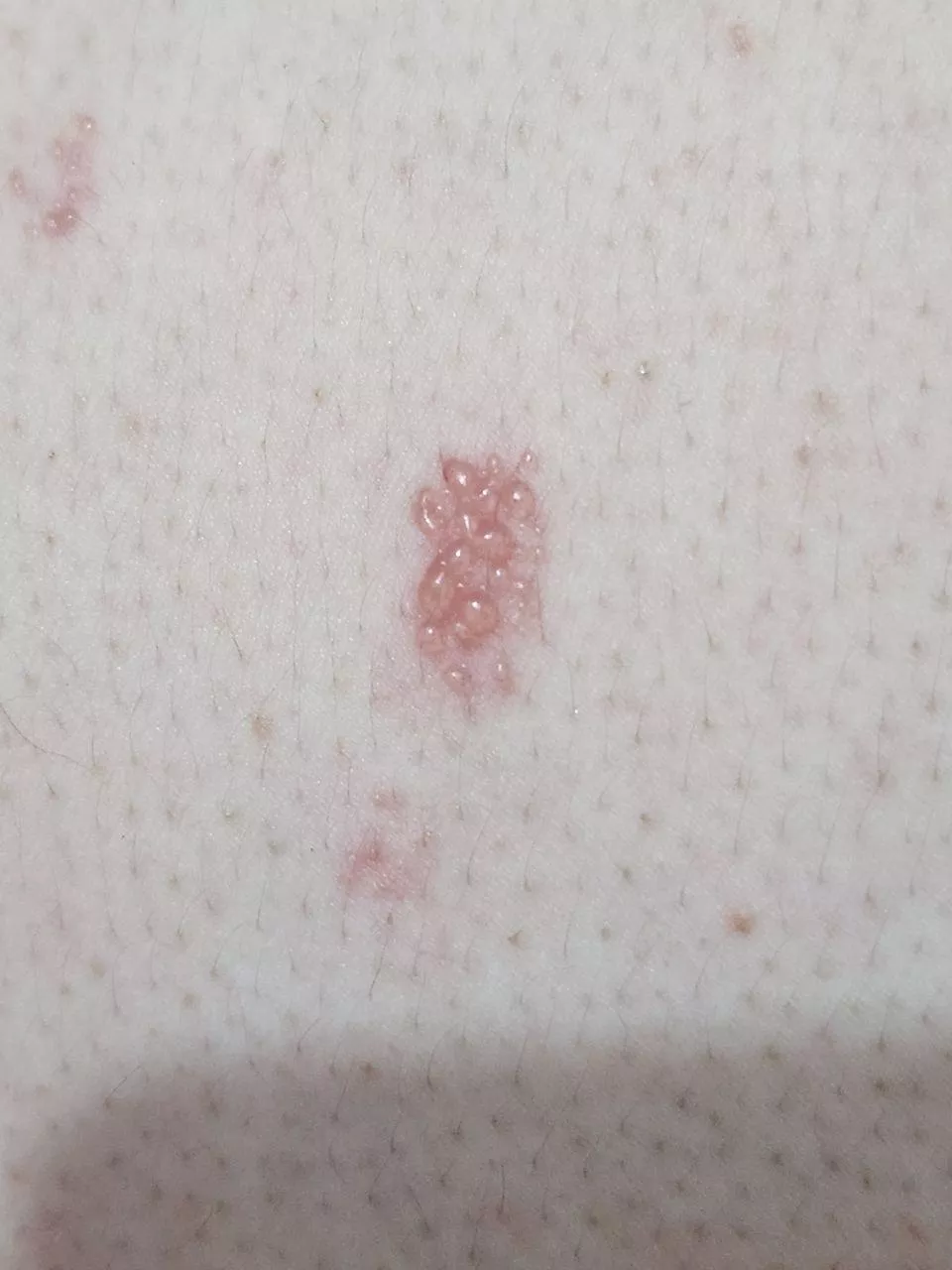 Shingles. My back has never hurt so much.