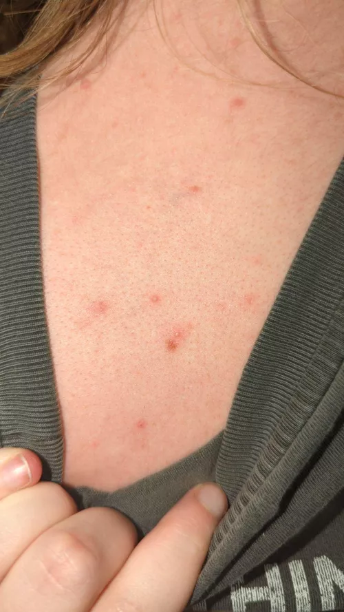 Little whiteheads on boyfriend's back 