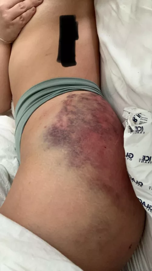 *TW* I’m a huge masochist, so don’t click if you don’t wanna see lots of bruising