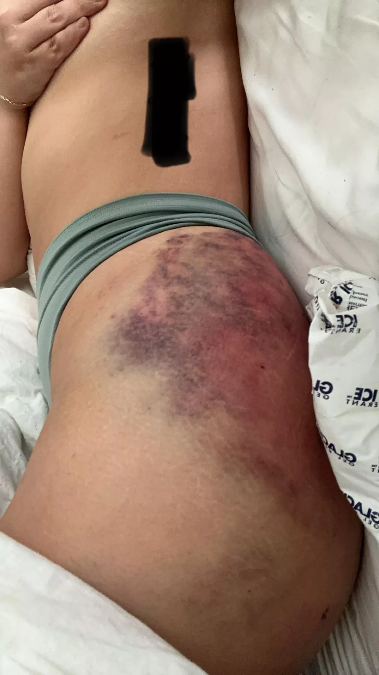 *TW* I’m a huge masochist, so don’t click if you don’t wanna see lots of bruising