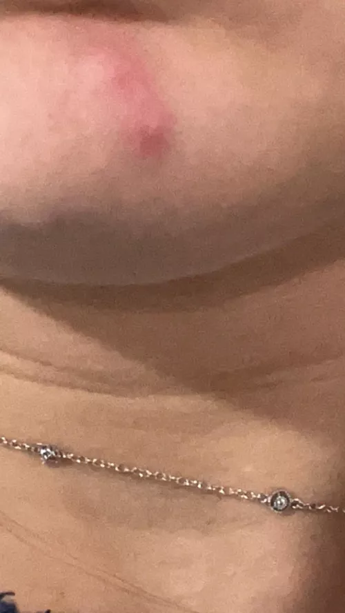 i have a double pimple????