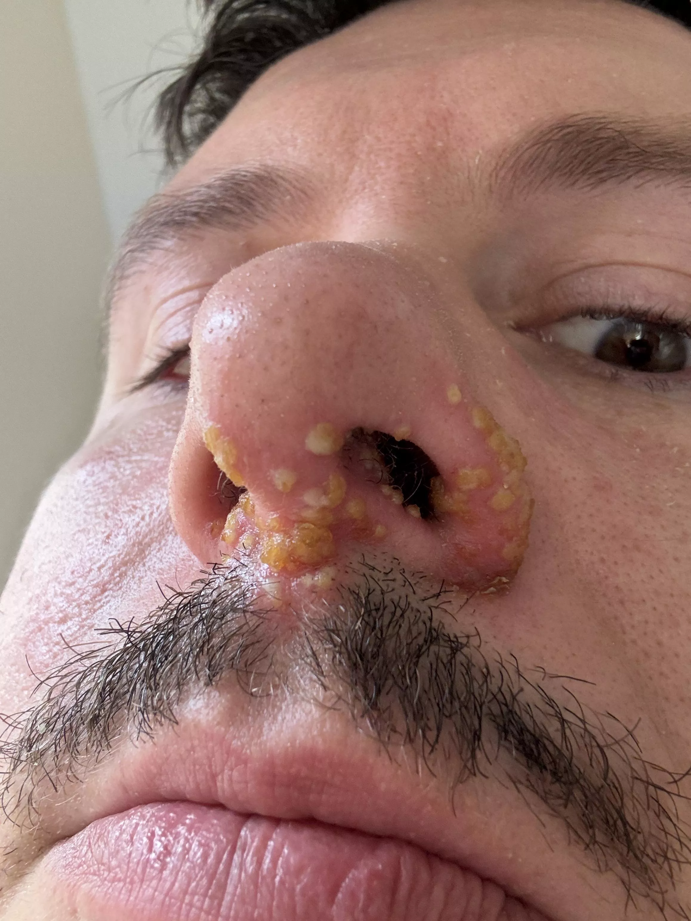 Cold Sores or Shingles?