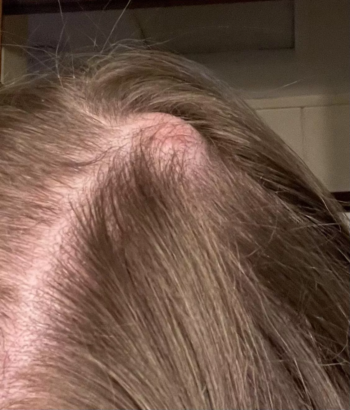 Pilar cyst to be removed 