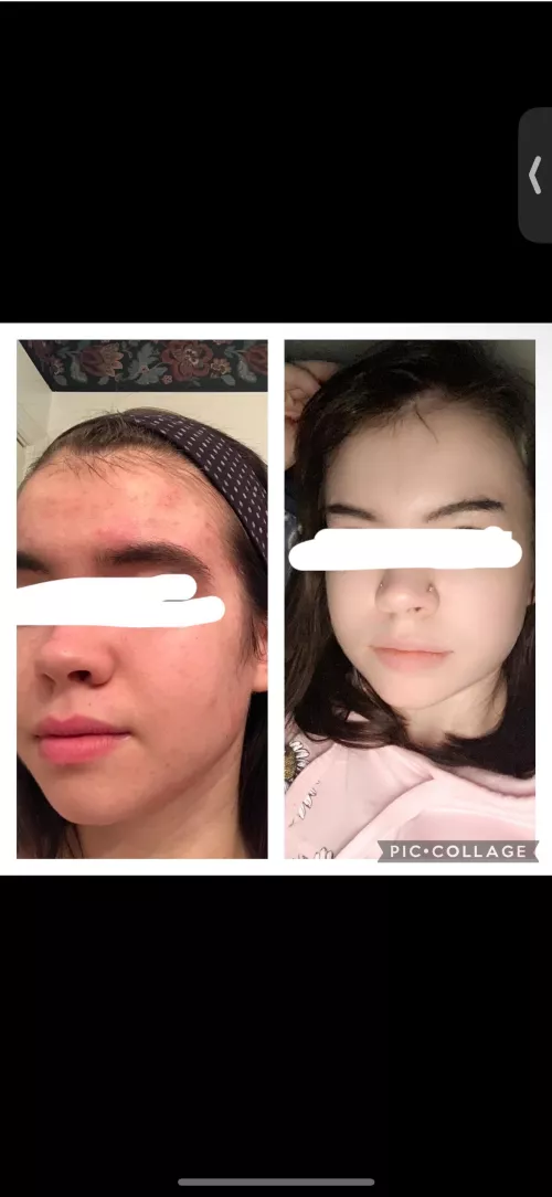 Skin picking disorder before/after