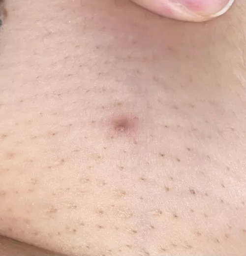 Ingrown from my last laser hair removal session :(
