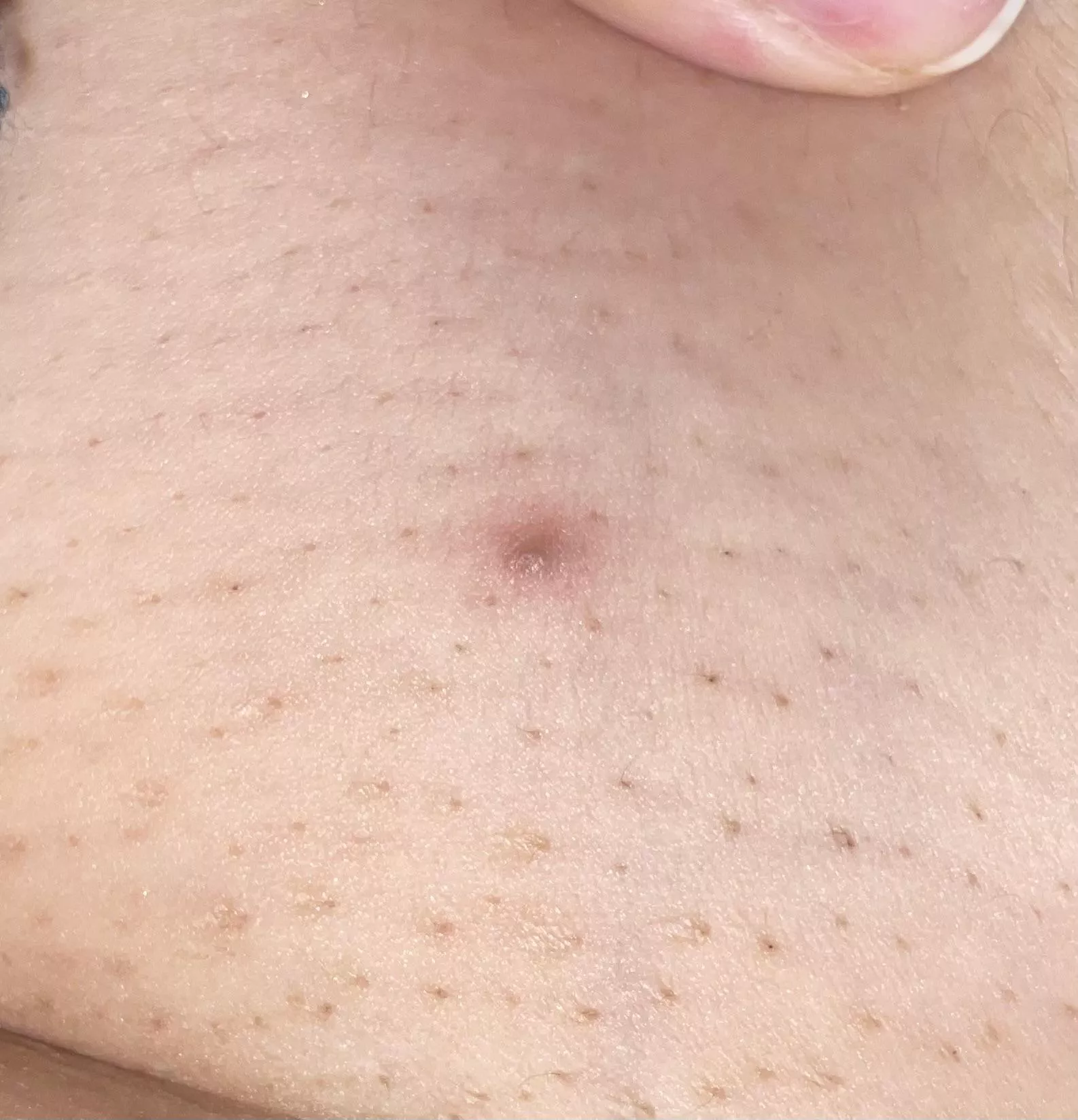 Ingrown from my last laser hair removal session :(