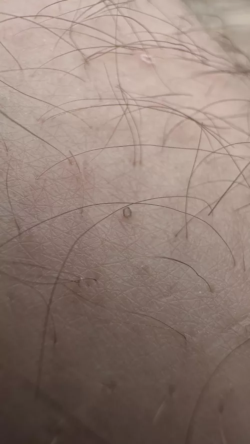 My husband gets what we call “uzumakis”